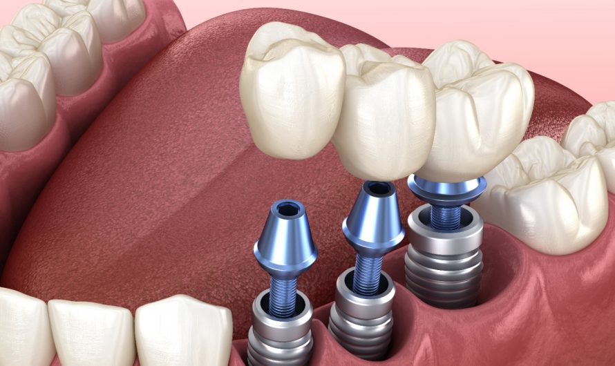 Имплантация зубов: восстановление уверенности и комфорта